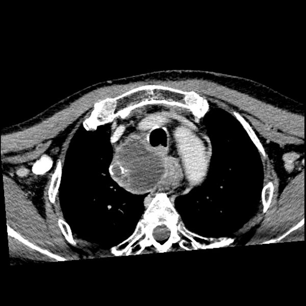 File:Anaplastic thyroid carcinoma (Radiopaedia 79087-92034 B 14).jpg