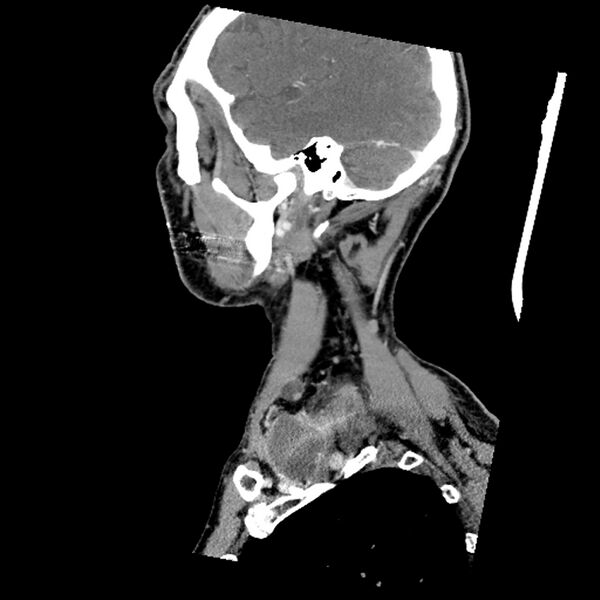 File:Anaplastic thyroid carcinoma (Radiopaedia 79087-92034 C 23).jpg