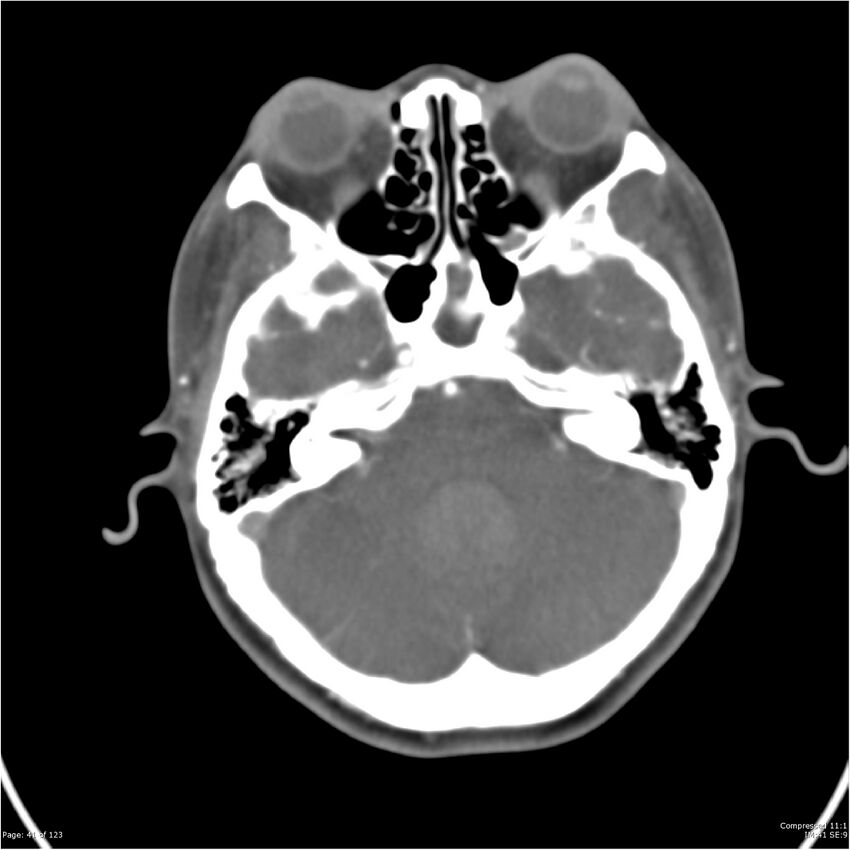 Aneurysmal subarachnoid hemorrhage and Moya Moya disease (Radiopaedia 34306-35593 Axial CT COW 41).jpg