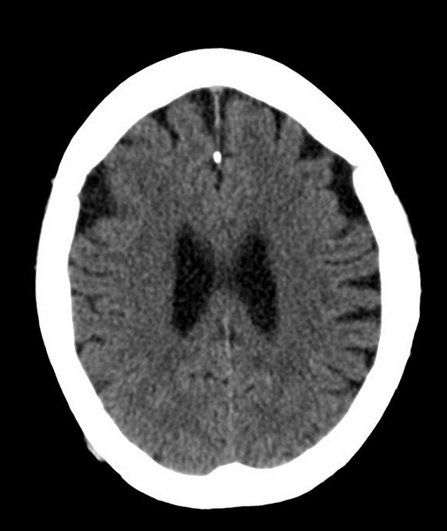 File:Anomalous intracranial venous drainage (Radiopaedia 28161-28418 Axial 32).png