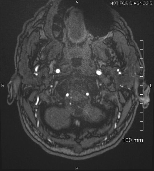 File:Anterior cerebral artery aneurysm (Radiopaedia 80683-94127 Axial MRA 5).jpg