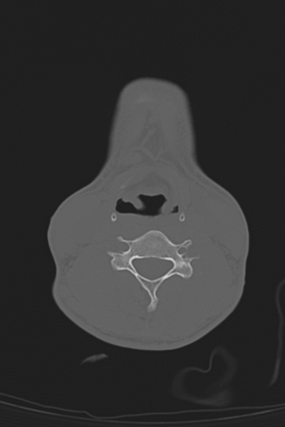 File:Anterior nasal spine fracture (Radiopaedia 46138-50494 Axial bone window 82).png