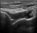 Anterior talofibular ligament tear (Radiopaedia 46877).jpg