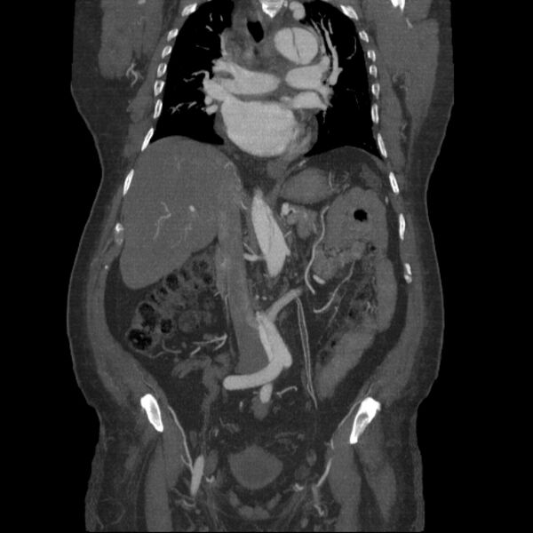 File:Aortic dissection (Radiopaedia 28802-29105 B 17).jpg