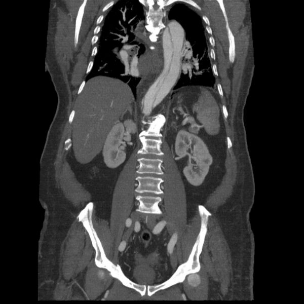 File:Aortic dissection (Radiopaedia 28802-29105 B 24).jpg