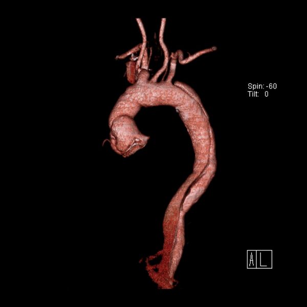 File:Aortic dissection - De Bakey type III - Stanford B (Radiopaedia 21903-21882 3D C+ arterial phase 16).jpg