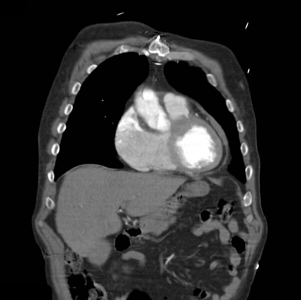 File:Aortic dissection with rupture into pericardium (Radiopaedia 12384-12647 B 9).jpg