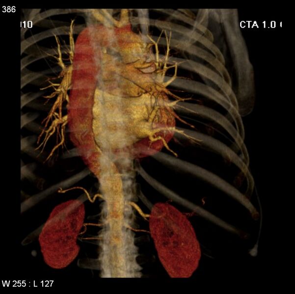 File:Aortic dissection with rupture into pericardium (Radiopaedia 12384-12647 C+ arterial phase 18).jpg