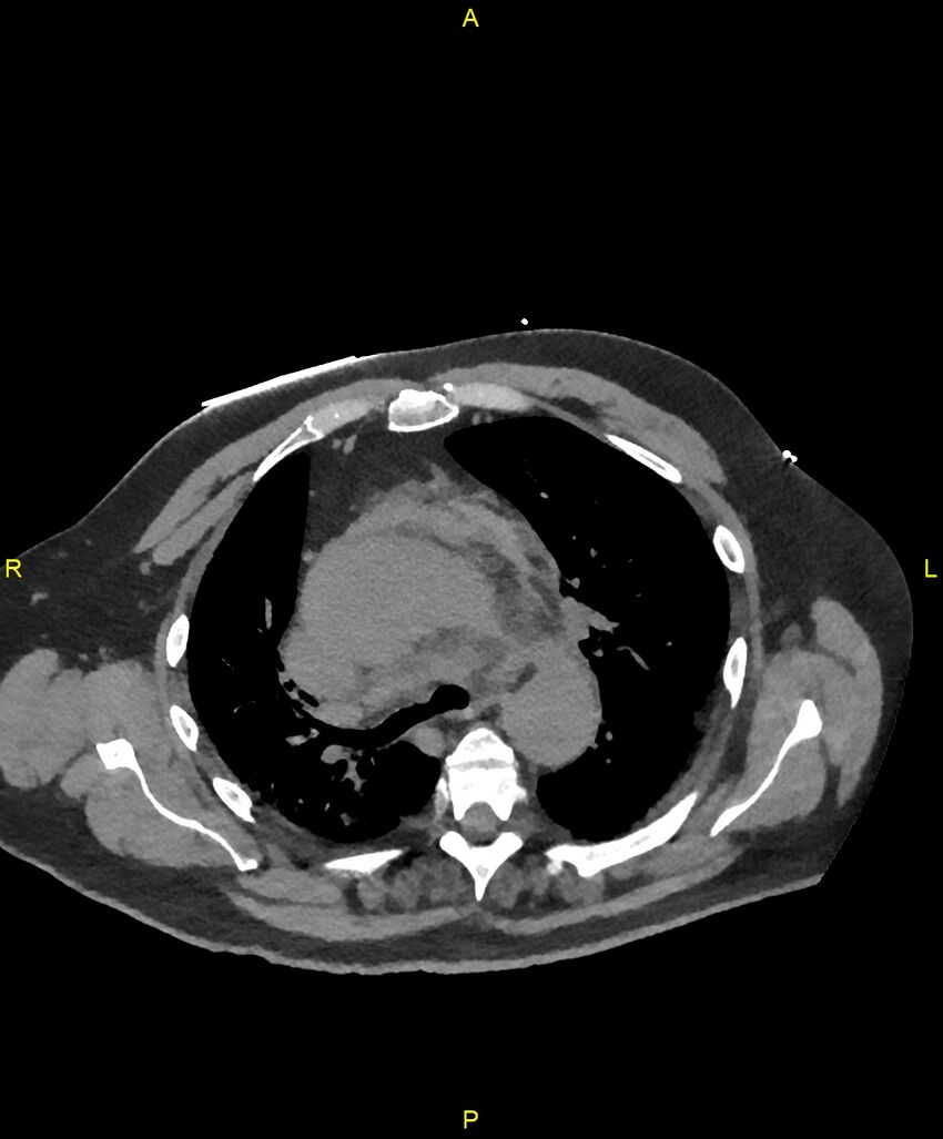 Aortic rupture (Radiopaedia 88822-105594 Axial non-contrast 74).jpg