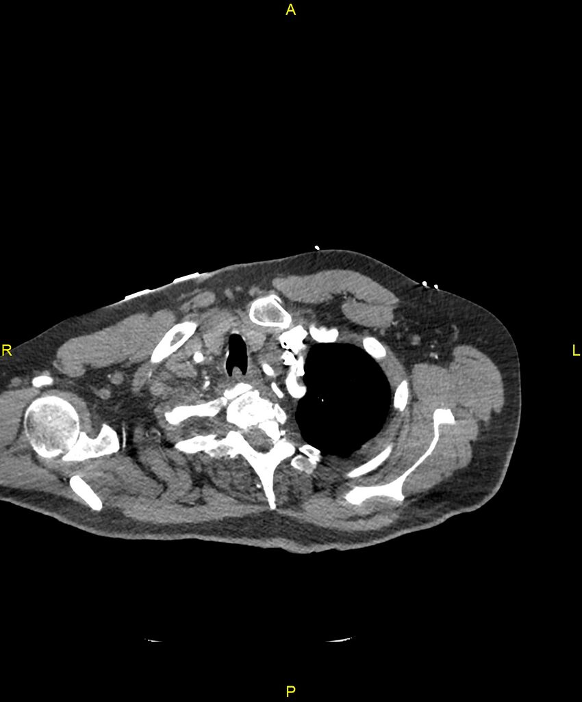 Aortic rupture (Radiopaedia 88822-105594 B 26).jpg