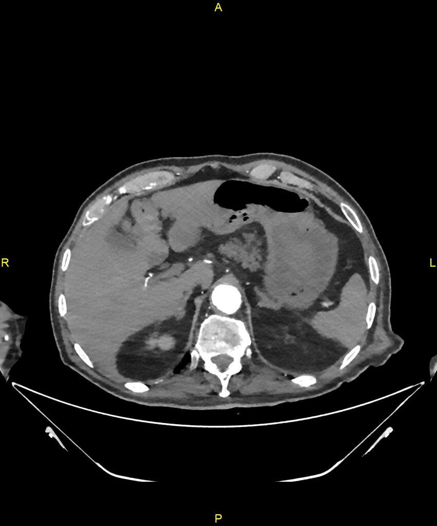 Aortoenteric fistula (Radiopaedia 84308-99603 B 64).jpg