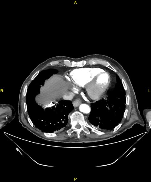 File:Aortoenteric fistula (Radiopaedia 84308-99603 B 9).jpg