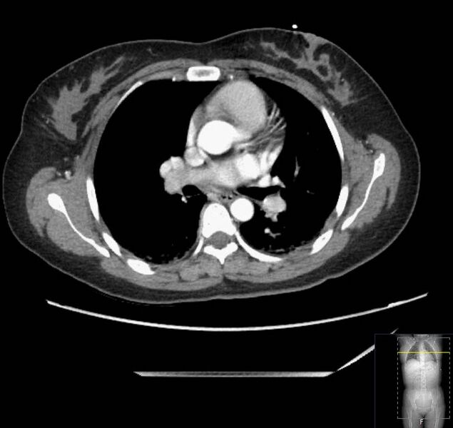 File:Appendicitis (CT angiogram) (Radiopaedia 154713-127660 Axial 203).jpg