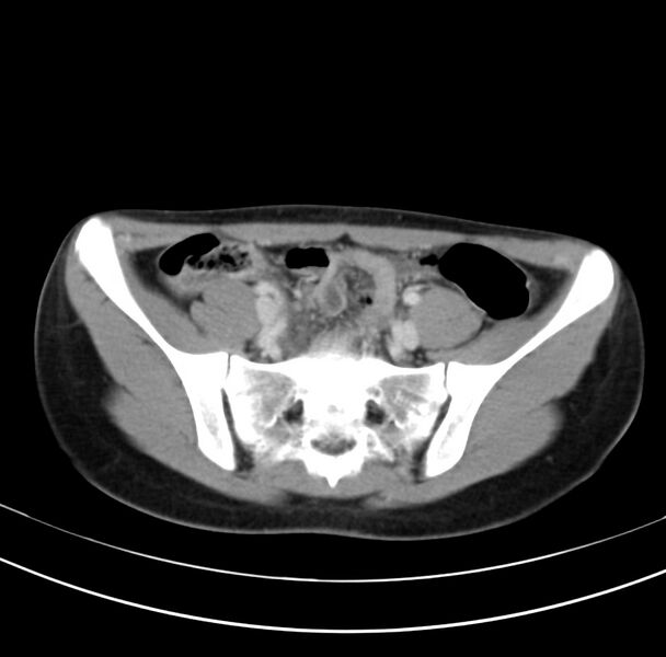 File:Appendicitis and incidental bicornuate uterus (Radiopaedia 22833-22853 B 34).jpg