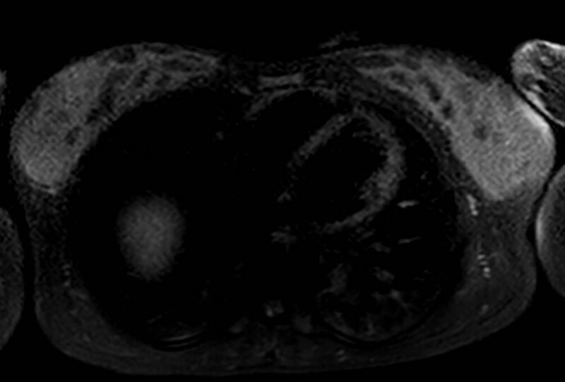 File:Appendicitis in gravida (MRI) (Radiopaedia 89433-106395 Axial T2 SPAIR 1).jpg