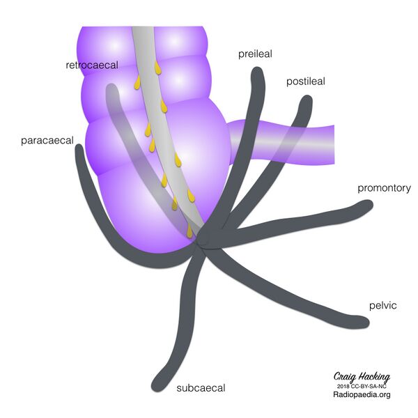 File:Appendix position (diagram) (Radiopaedia 62911-71293 A 1).jpeg