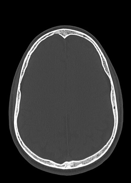 File:Arrow injury to the head (Radiopaedia 75266-86388 Axial bone window 89).jpg