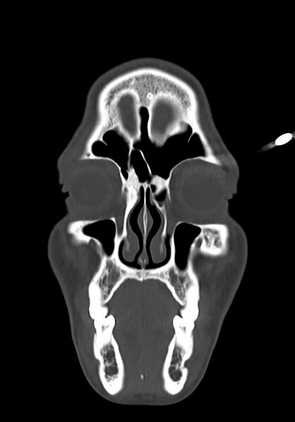 File:Arrow injury to the head (Radiopaedia 75266-86388 Coronal bone window 22).jpg