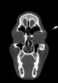 Arrow injury to the head (Radiopaedia 75266-86388 Coronal bone window 22).jpg