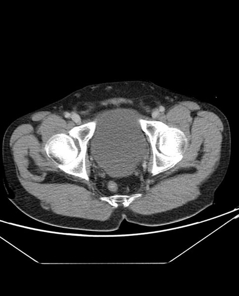 File:Arterial occlusive mesenteric ischemia (Radiopaedia 84641-100054 A 113).jpg