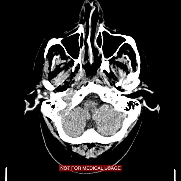 File:Artery of Percheron infarction (Radiopaedia 28679-28967 Axial non-contrast 16).jpg