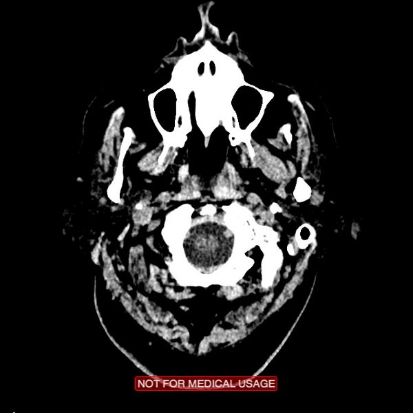 File:Artery of Percheron infarction (Radiopaedia 28679-28967 Axial non-contrast 5).jpg