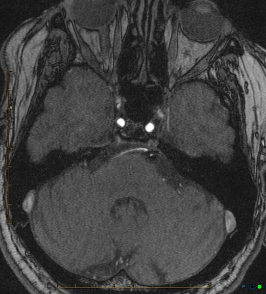 File:Artifactual basilar artery stenosis due to metallic stent (Radiopaedia 31206-31922 Axial MRA 6).jpg