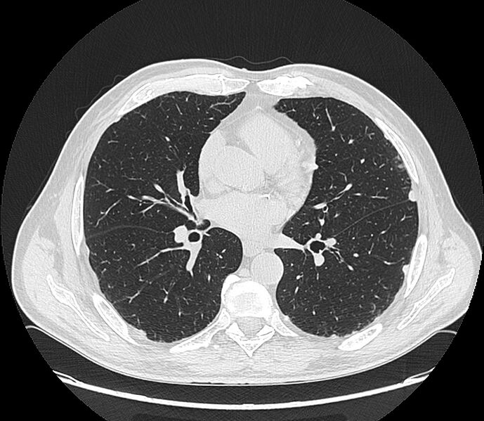 File:Asbestos pleural placques (Radiopaedia 57905-64872 Axial lung window 134).jpg