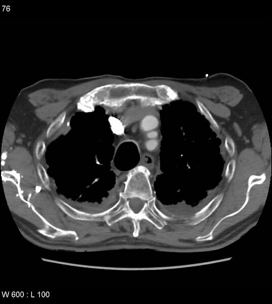 File:Asbestos related lung and pleural disease (Radiopaedia 14377-14301 D 12).jpg