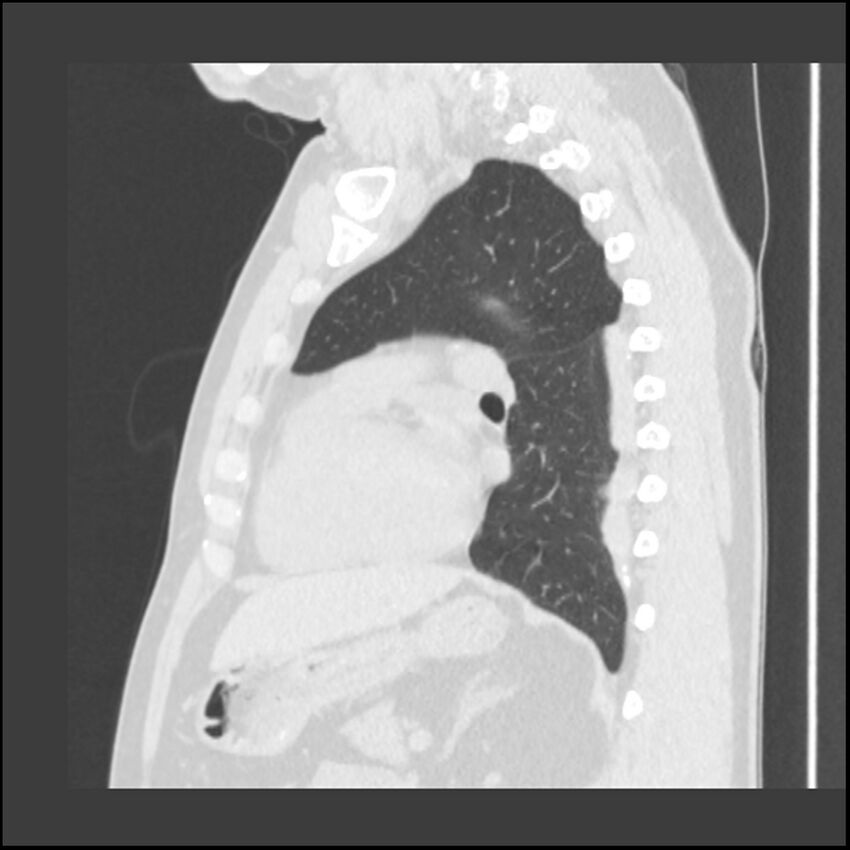 Asbestosis (Radiopaedia 45002-48961 Sagittal lung window 51).jpg