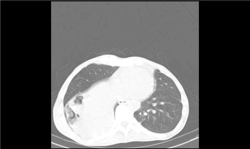 File:Aspergilloma (Radiopaedia 20788-20701 Axial lung window 26).jpg