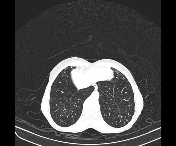 File:Aspergillomas (Radiopaedia 66779-76110 Axial lung window 39).jpg