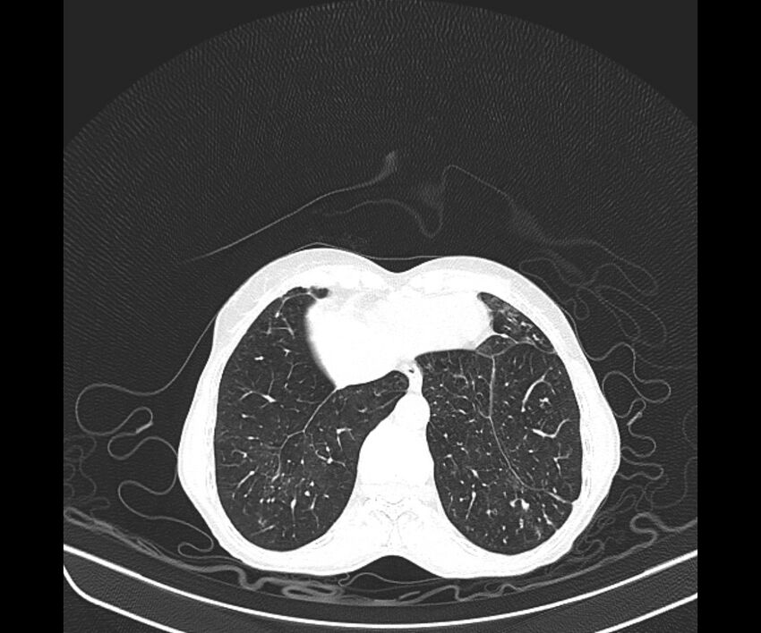 Aspergillomas (Radiopaedia 66779-76110 Axial lung window 39).jpg