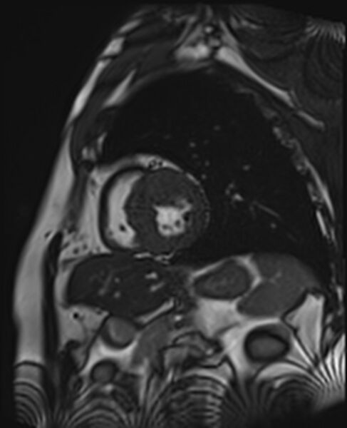 File:Asymmetric septal hypertrophic cardiomyopathy - systolic anterior motion of mitral leaflet (Radiopaedia 72795-83445 C 4).jpg
