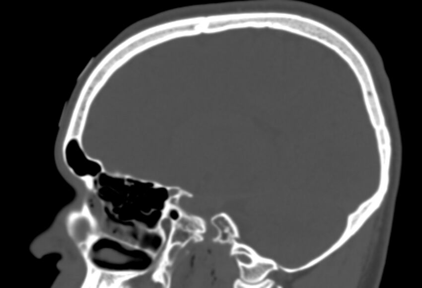 Asymptomatic occipital spur (Radiopaedia 87753-104201 Sagittal bone window 119).jpg