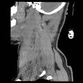 Atlanto-occipital dislocation (Radiopaedia 44648-48412 A 27).jpg