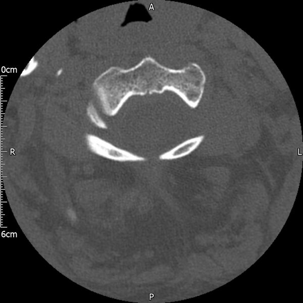 File:Atlas fracture with Currarino type A congenital defect (Radiopaedia 71747-82144 Axial bone window 50).jpg