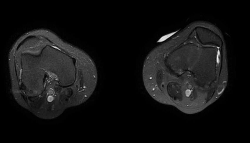 Atypical lipomatous tumor - thigh (Radiopaedia 68975-78734 Axial T2 fat sat 11).jpg