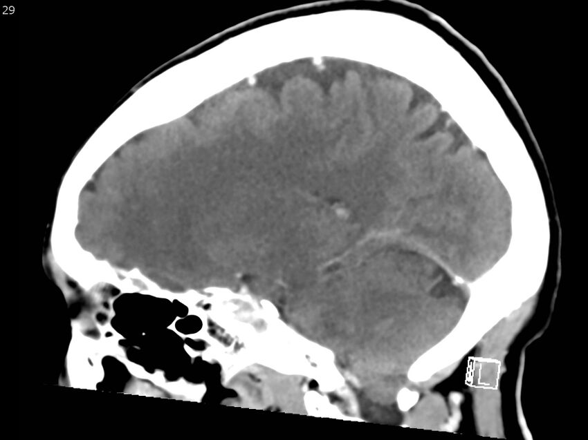 Atypical meningioma - intraosseous (Radiopaedia 64915-73867 F 28).jpg