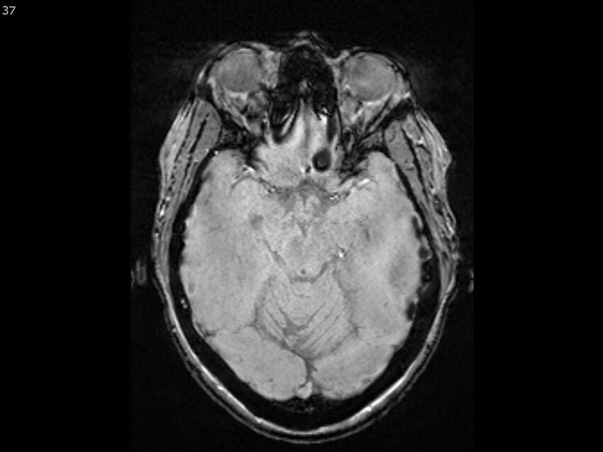 Atypical meningioma - intraosseous (Radiopaedia 64915-74572 Axial SWI 37).jpg