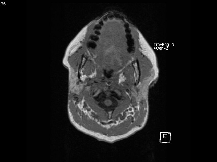 Atypical meningioma - intraosseous (Radiopaedia 64915-74572 Axial T1 36).jpg