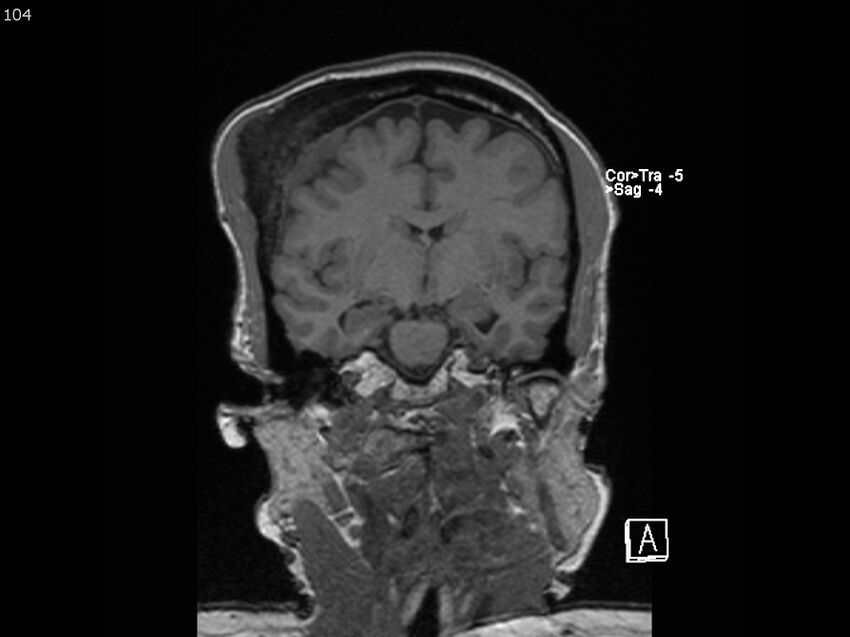 Atypical meningioma - intraosseous (Radiopaedia 64915-74572 Coronal T1 104).jpg