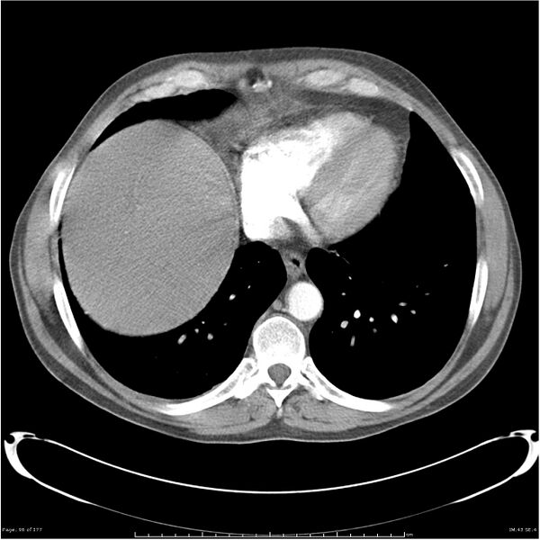 File:Atypical pneumonia - Q fever (Radiopaedia 21993-21989 C+ arterial phase 38).jpg