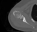 Avulsion fracture - greater tuberosity of humerus (Radiopaedia 71216-81514 Axial bone window 34).jpg
