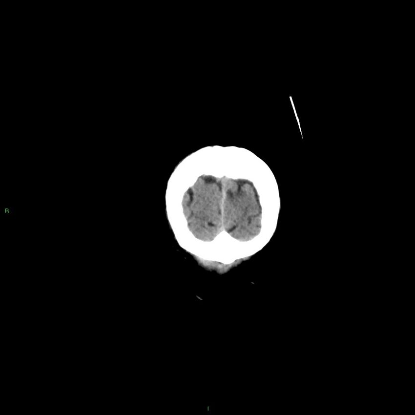 Basal ganglia hemorrhage (Radiopaedia 58350-65473 Coronal non-contrast 7).jpg