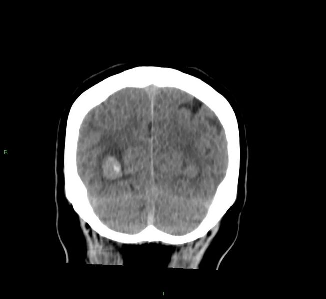 File:Basal ganglia hemorrhage (Radiopaedia 58763-65985 Coronal non-contrast 19).jpg