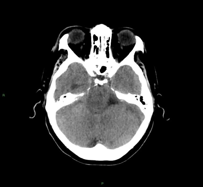 File:Basal ganglia hemorrhage (Radiopaedia 58775-66008 Axial non-contrast 42).jpg