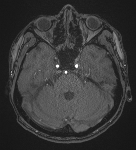 File:Basal ganglia subacute infarct (Radiopaedia 80201-93521 Axial MRA 27).png
