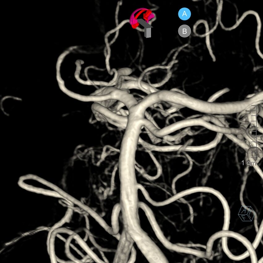 Basilar artery perforator aneurysm (Radiopaedia 82455-97734 3D view left VA 106).jpg