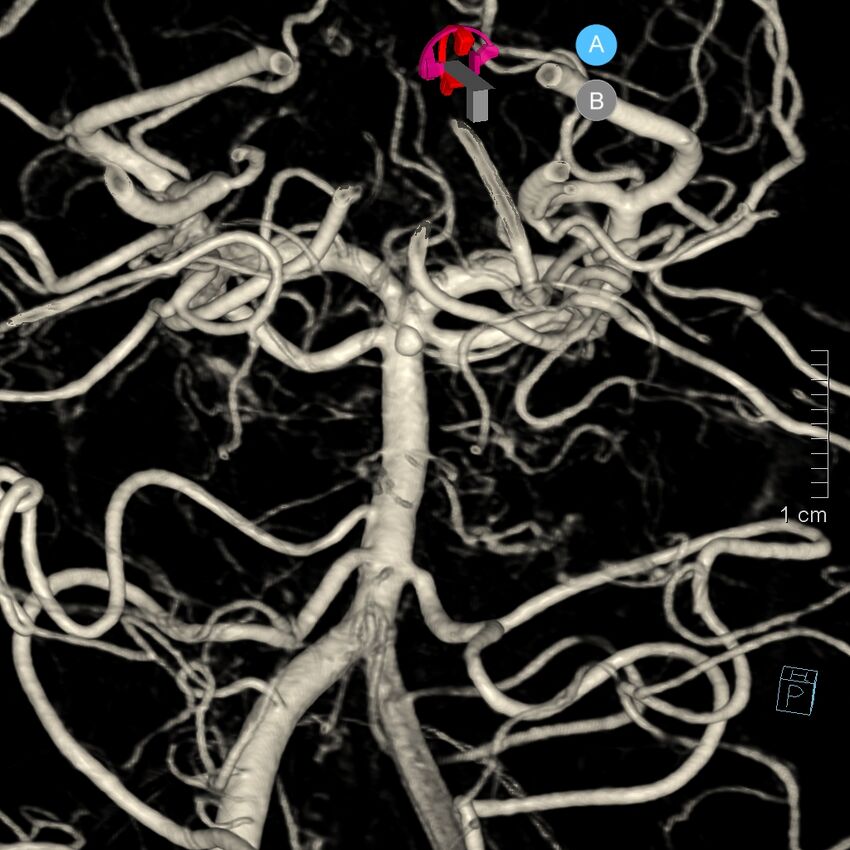 Basilar artery perforator aneurysm (Radiopaedia 82455-97734 3D view left VA 86).jpg